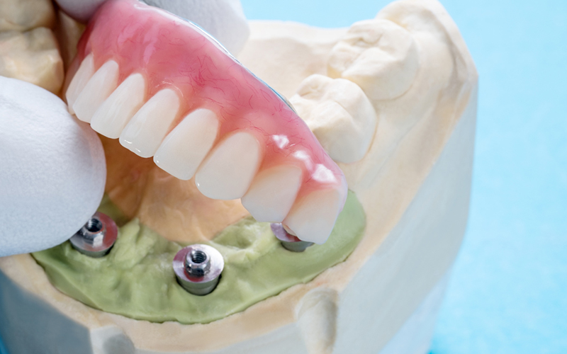All on X lifestyle transformation at Greenwood Park Dentistry Kingston
