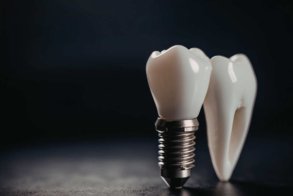 Dental implants after trauma recovery at Greenwood Park Dentistry Kingston
