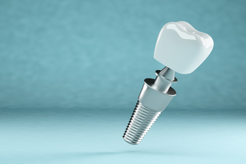 Dental implants mini vs standard comparison at Greenwood Park Dentistry Kingston
